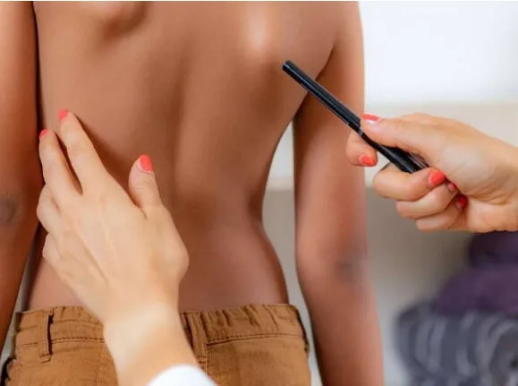 Escoliosis Escápula alada