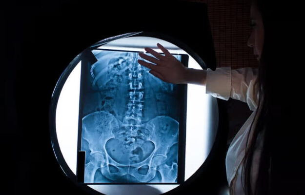 Diagnostic Insights of Severe Scoliosis Through X-Ray Imaging and Its Implications