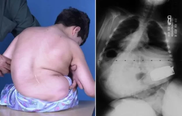 側弯症の重症例と患者への影響を検証する