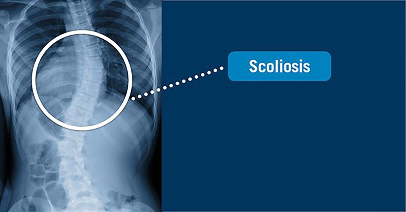 Chirurgie de la scoliose