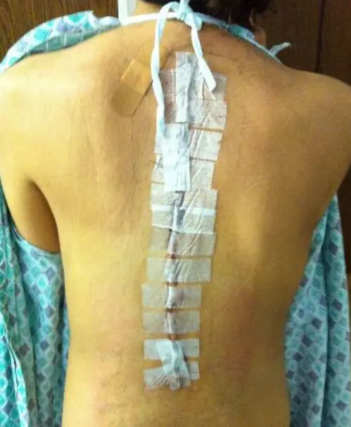 Tiempo de recuperación de la cirugía de escoliosis: Comprender los plazos de recuperación y los cuidados postoperatorios tras la cirugía de escoliosis