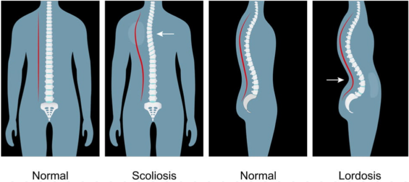 Lordose und Skoliose: Die einzigartigen Merkmale und das Management der beiden Zustände verstehen