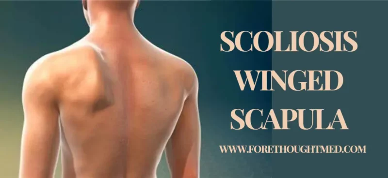 Skoliose Geflügelte Skapula: Die Auswirkungen der geflügelten Skapula auf Haltung und Funktion bei Skoliosepatienten