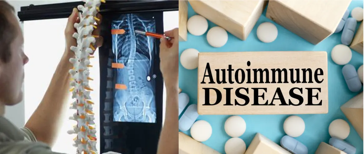 脊柱側湾症と自己免疫疾患の関連を探る:影響と管理戦略