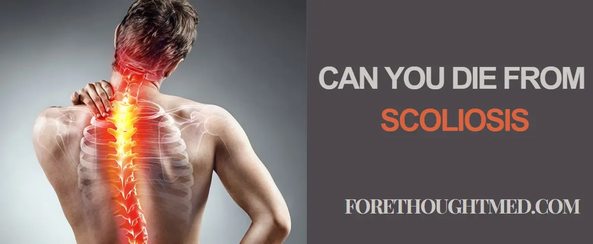 Can You Die from Scoliosis