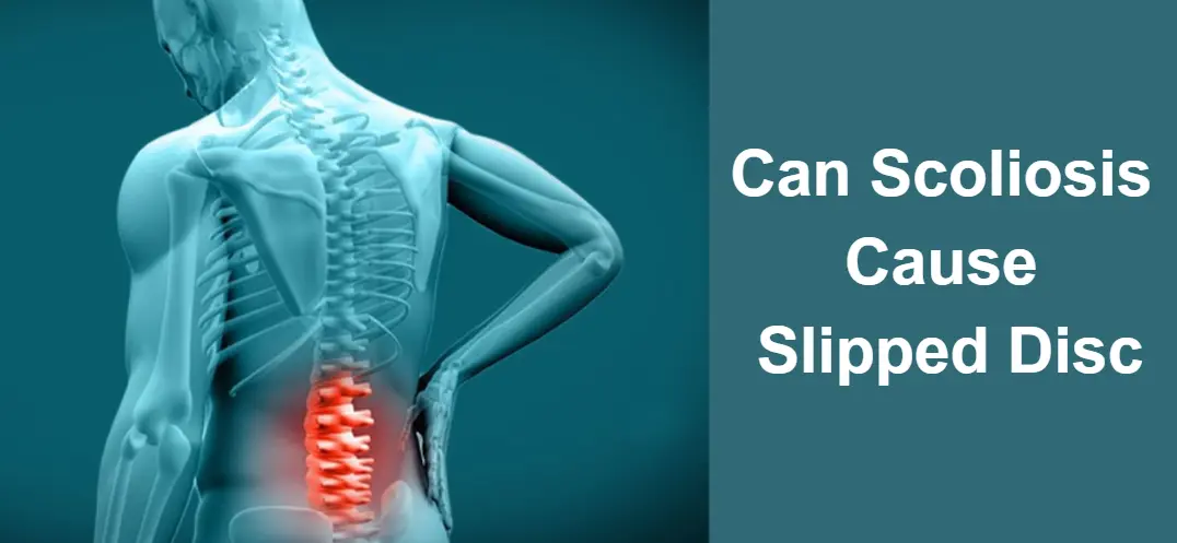 Can Scoliosis Cause Slipped Disc