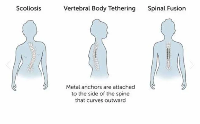 Scoliosis Tethering: How This Cutting-Edge Procedure Works and Its Effectiveness in Treating Scoliosis
