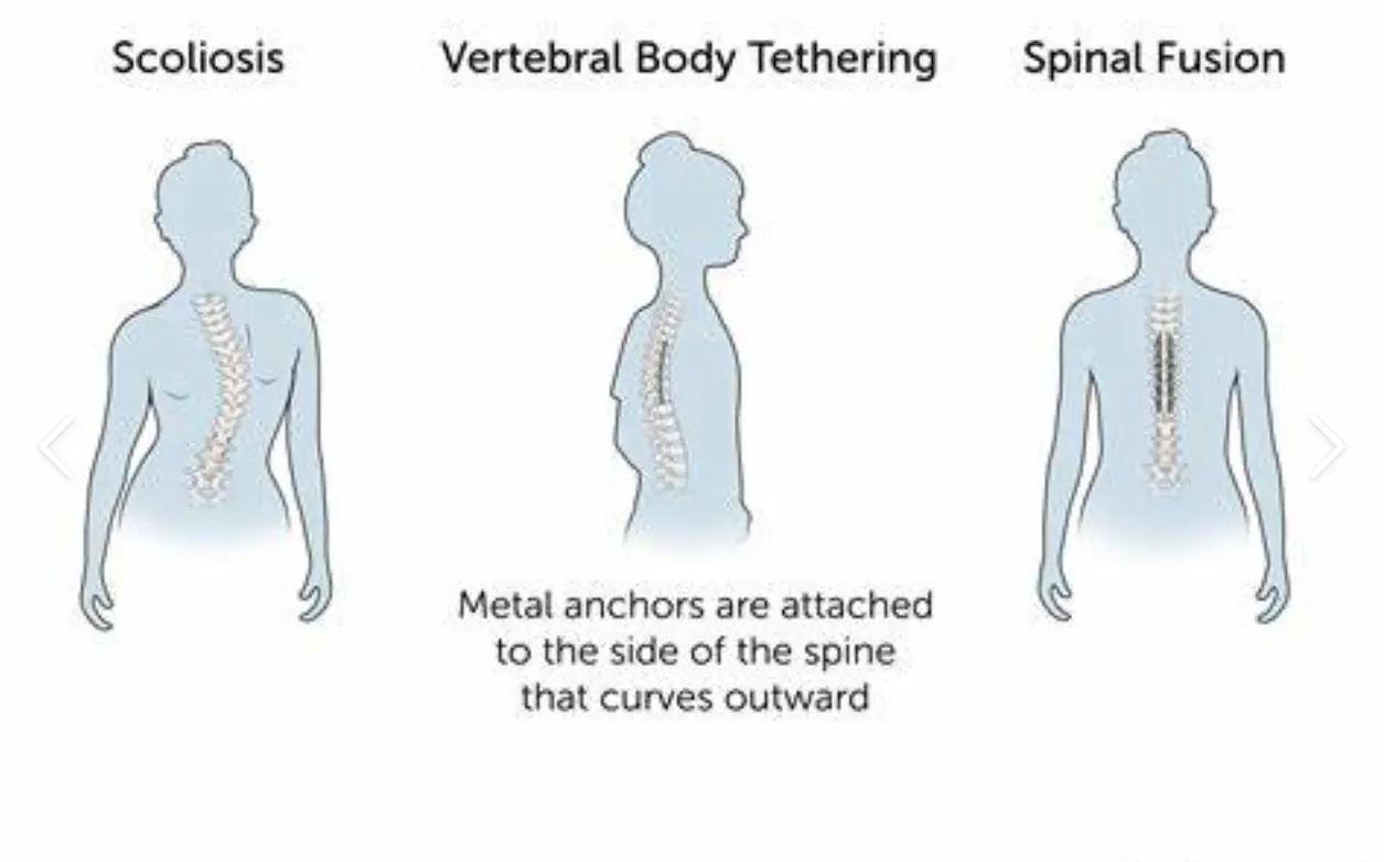 Scoliosis Tethering: How This Cutting-Edge Procedure Works and Its Effectiveness in Treating Scoliosis