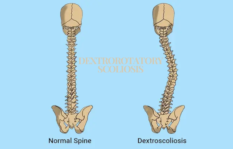 Escoliose dextrorotatória: Compreender as causas, os sintomas e as opções de tratamento