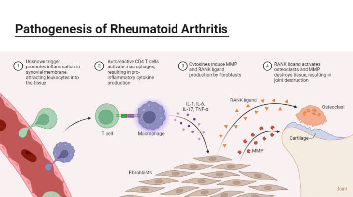Rheumatoide Arthritis - Skoliose: Der Zusammenhang und die Behandlungsmöglichkeiten