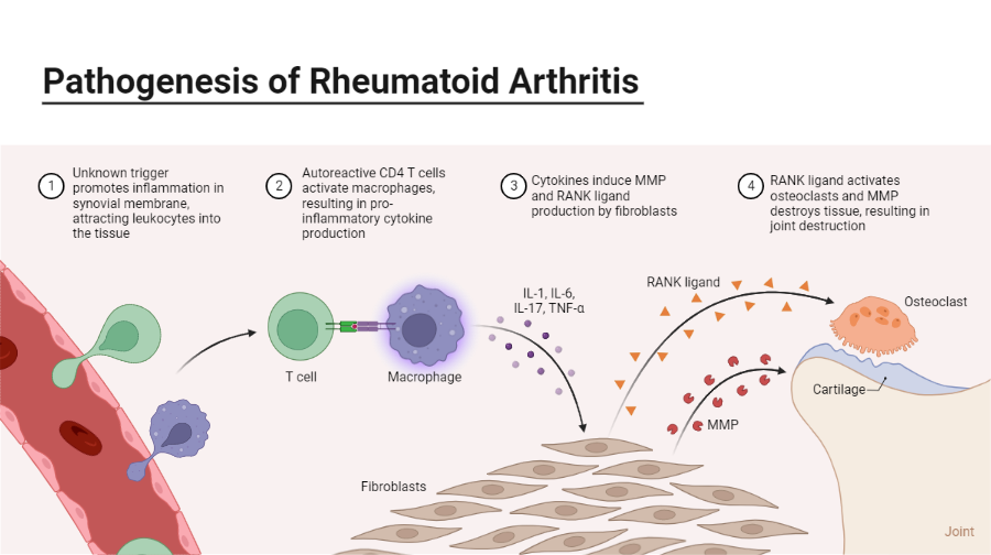 Rheumatoid Arthritis Scoliosis: Understanding the Connection and Treatment Options
