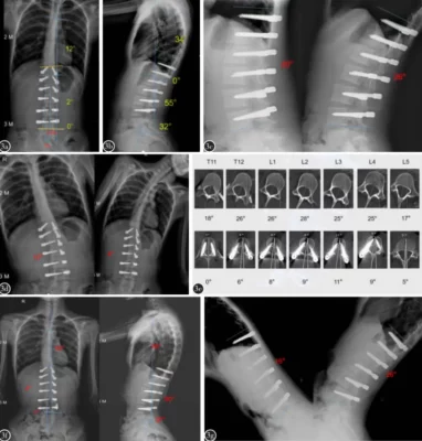 Tethering-Skoliose: Innovative nicht-fusionierende Techniken für eine wirksame Skoliosekorrektur