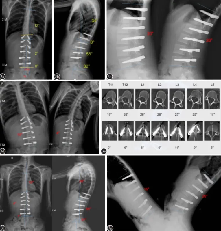 Tethering Scoliosis: técnicas innovadoras sin fusión para una corrección eficaz de la escoliosis
