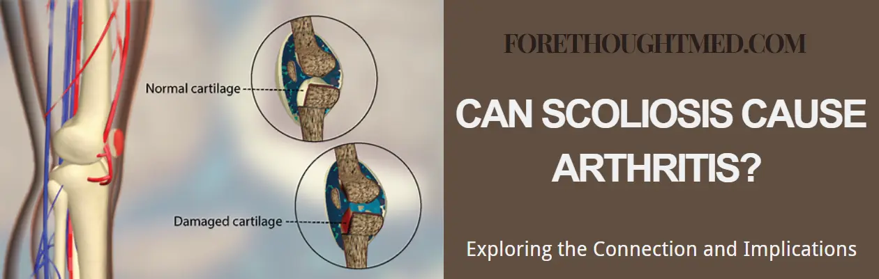 A escoliose pode causar artrite? Explorando a conexão e as implicações