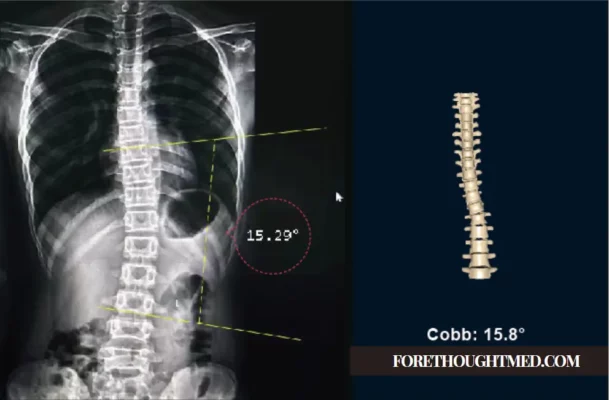 Umgang mit 16-Grad-Skoliose: Behandlungsansätze und Managementstrategien