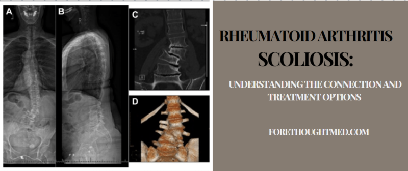 Rheumatoide Arthritis Skoliose