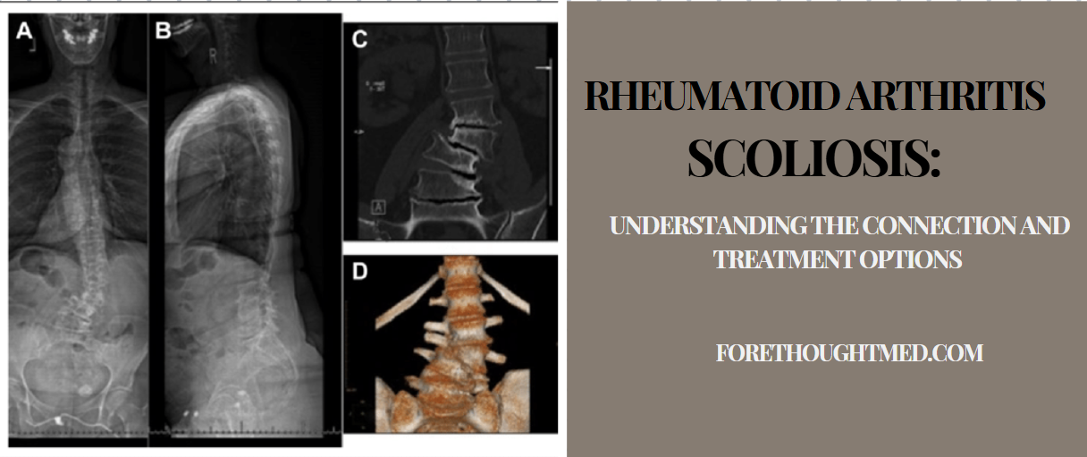 Rheumatoide Arthritis Skoliose