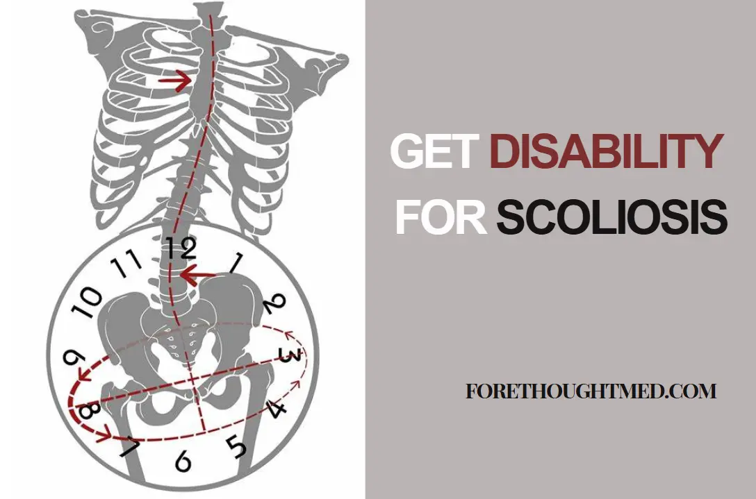 Insights into the Application Process and Challenges of Securing Disability Benefits for Scoliosis