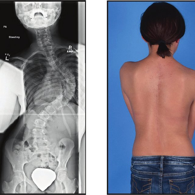 Assessing the Potential Life-Threatening Risks Associated with Severe Scoliosis