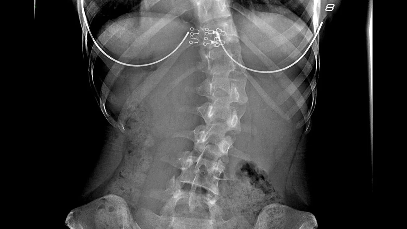 Shamar-Skoliose verstehen: Merkmale und Diagnose dieses einzigartigen Zustands