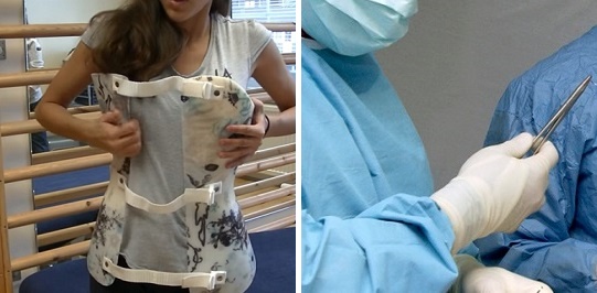 Scoliosis Life Expectancy: Comprehensive Insights into How Treatment and Lifestyle Choices Influence Longevity