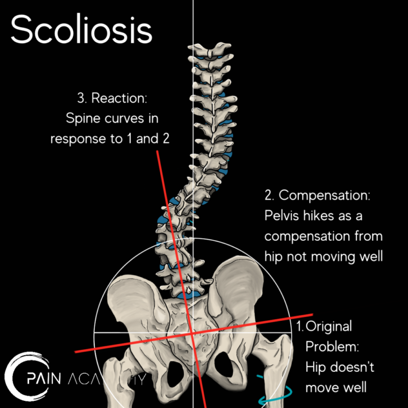 Innovative Approaches to Scoliosis Education: Bridging the Gap Between Patients and Providers