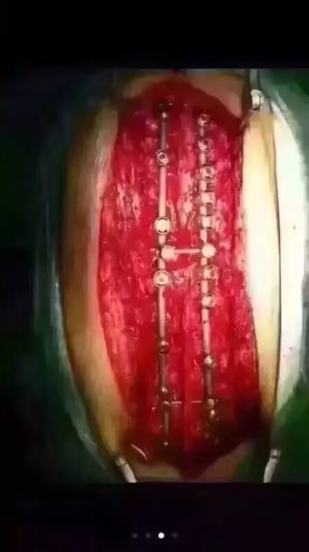 Recuperación tras la cirugía de escoliosis: Qué esperar durante el proceso de recuperación tras una cirugía de escoliosis