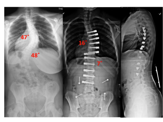 Does Scoliosis Surgery Make You Taller: Understanding the Effects of Scoliosis Surgery on Body Height and Alignment