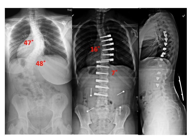 Does Scoliosis Surgery Make You Taller: Understanding the Effects of Scoliosis Surgery on Body Height and Alignment