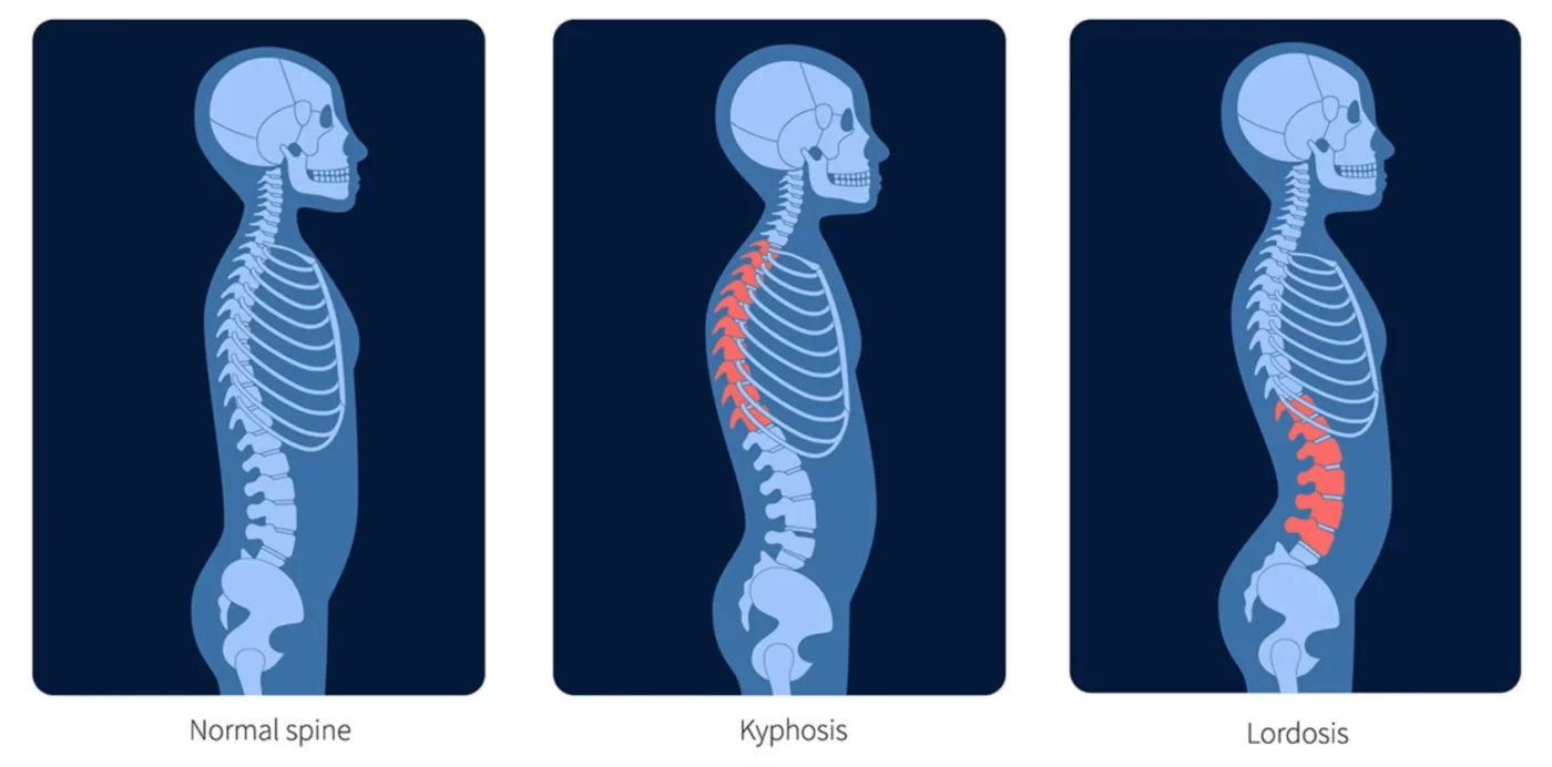 Lordosis vs Kyphosis vs Scoliosis: Comparing Different Types of Spinal Curvatures