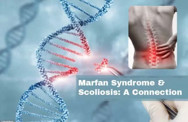 Síndrome de Marfan - Escoliosis: La conexión entre el síndrome de Marfan y la escoliosis