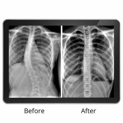 Effective Scoliosis Treatment Without Surgery: Alternatives to Surgical Intervention