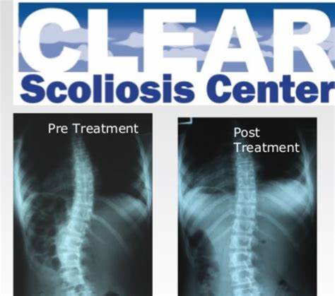 Clear Scoliosis Center: Como o Clear Scoliosis Center fornece cuidados especializados para pacientes com escoliose