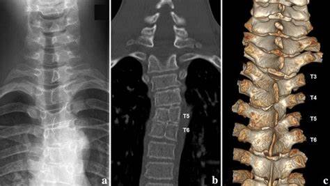 Cervicothoracic Scoliosis