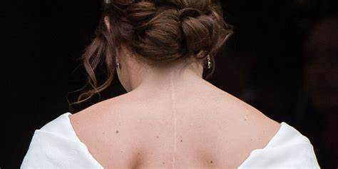 Princess Eugenie Scoliosis