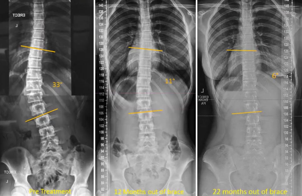 Scoliosis Assessment Physiotherapy