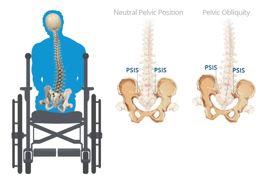 Understanding Pelvic Tilt Scoliosis
