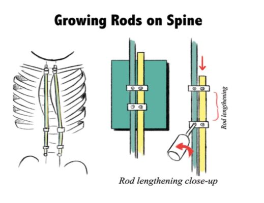 Compreender as hastes para cirurgia de escoliose: Tipos, usos e impacto na recuperação
