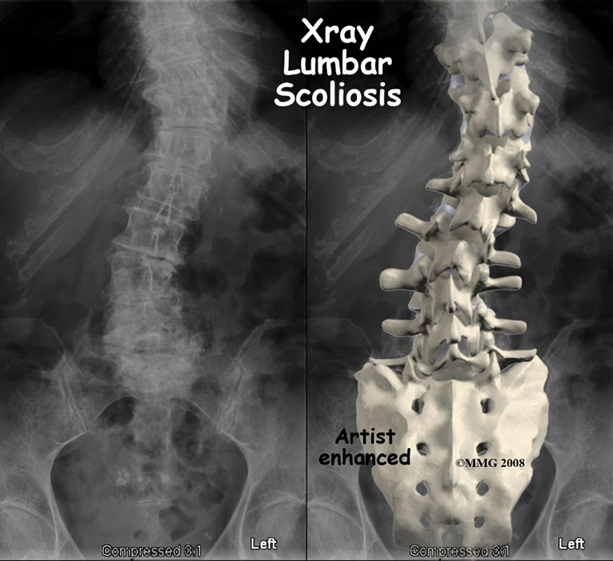Scoliosis XRay Series: Essential Imaging Techniques for Accurate Scoliosis Diagnosis