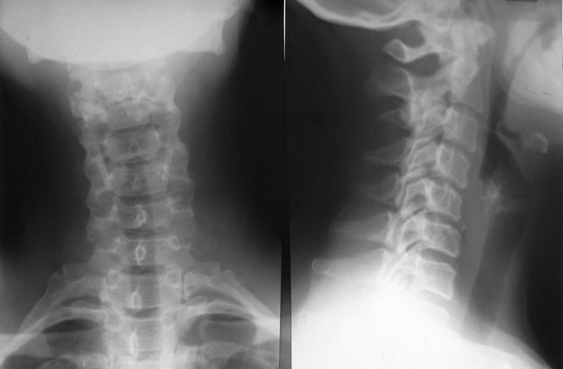 Escoliose Coluna cervical