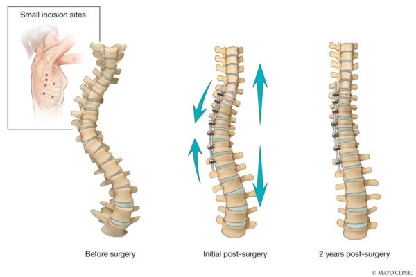 Scoliosis Tethering for Adults: Exploring the Benefits and Considerations of Tethering Procedures