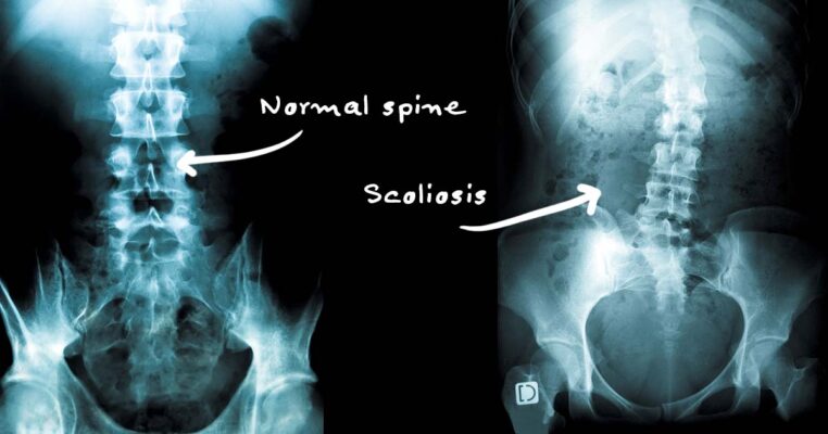 Positionnement de la scoliose aux rayons X :