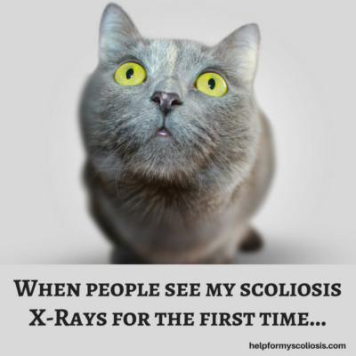 Scoliosis Fun Facts: Interesting Insights and Trivia About Spinal Curvature