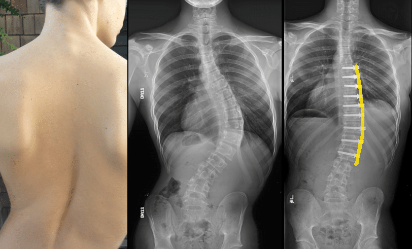 ASC Scoliosis Surgery