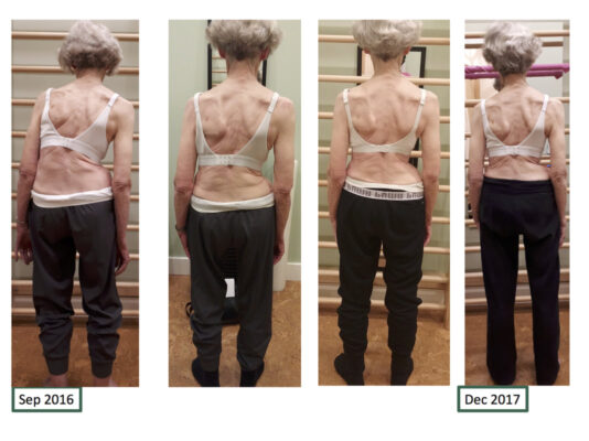 Before and After Scoliosis Brace: Visual and Functional Changes Observed in Patients Using Scoliosis Braces