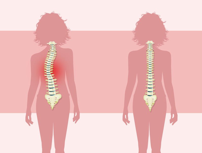Which of the Following Describes Structural Scoliosis? Understanding the Characteristics and Classification of Structural Scoliosis 2024