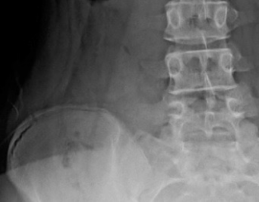 Wie die Risser Score Skoliose Behandlung: Ein umfassender Überblick