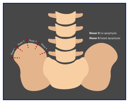 Scoliosis Risser Sign