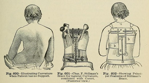 Old-Fashioned Scoliosis Brace