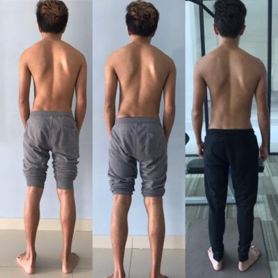 Escoliose após a cirurgia: Recuperação e gestão a longo prazo